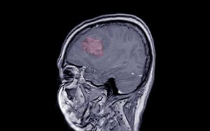 MRI Scan of Meningioma