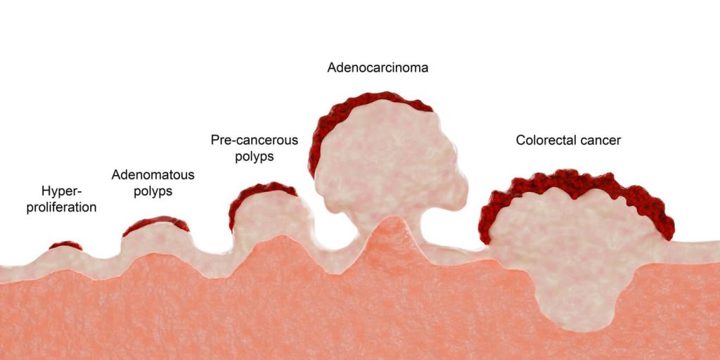 Hyperproliferation, adenomatous polyps and pre-cancerous polyps are benign. Adenocarcinoma and colorectal cancer are malign